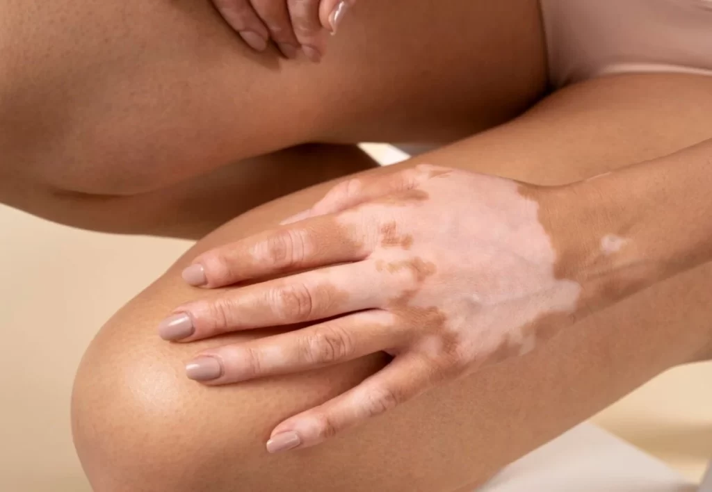 Woman showing her vitiligo skin parts