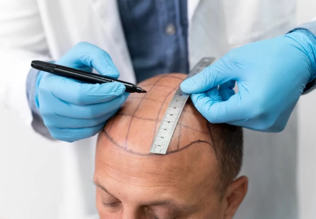 Male going through a follicular unit extraction process