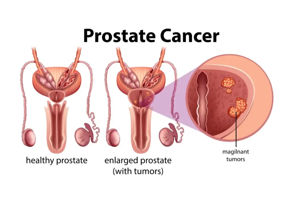 Prostate Cancer on White Background