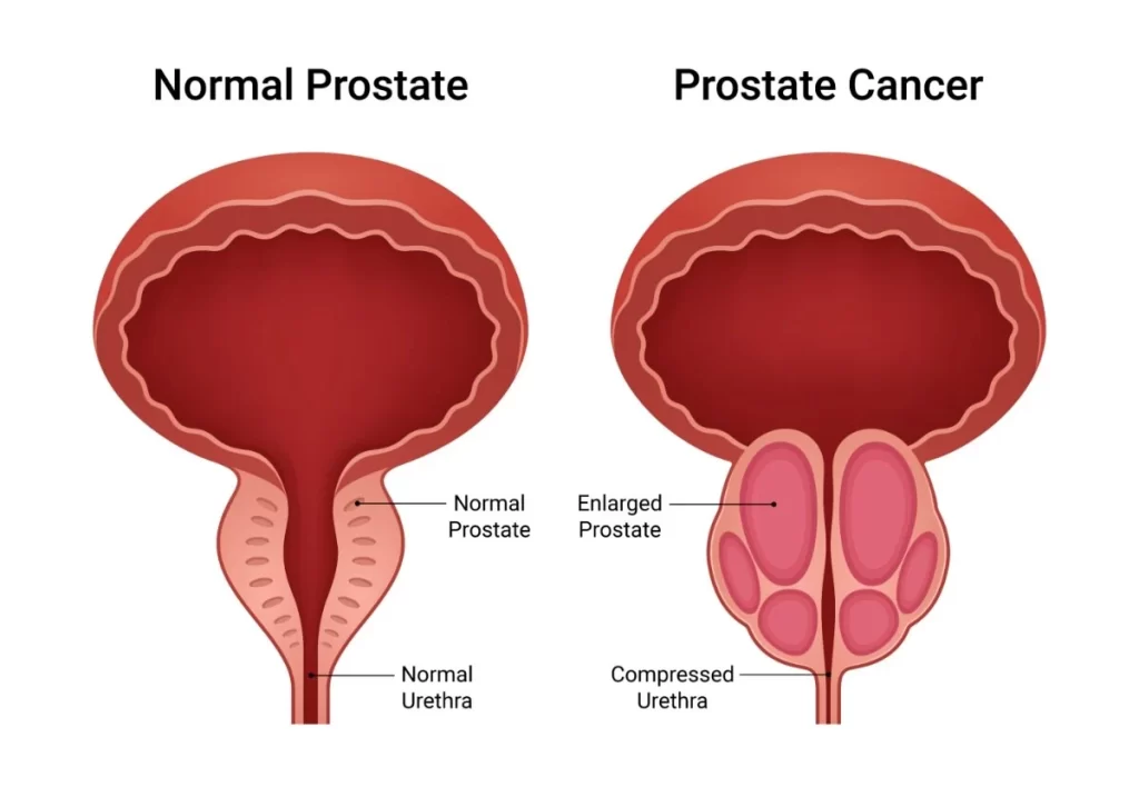 Normal Prostate and Prostate Cancer Inflammation