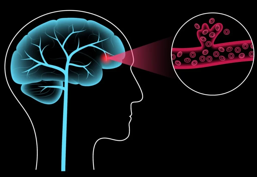 Brain stroke hemorrhagic