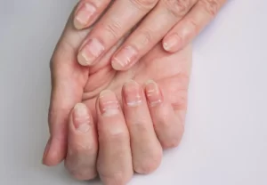 Closeup photo of nails with white stripes Lack of vitamins and minerals in the organism